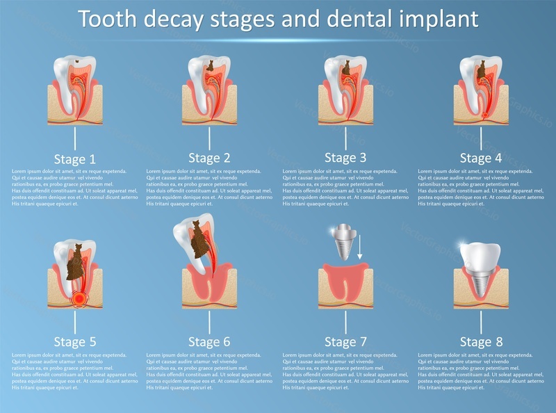 Стадии кариеса и зубной имплантат. Векторная иллюстрация. Стоматологическая медицина и концепция замещения. Учебный медико-анатомический плакат.