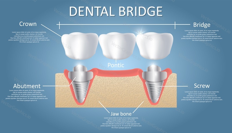 Схема зубного моста. Векторный образовательный плакат, медицинская инфографика. Мостовидный протез с опорой на имплантат состоит из одного искусственного зуба, соединенного с соседними зубными имплантатами. Несъемный зубной протез.