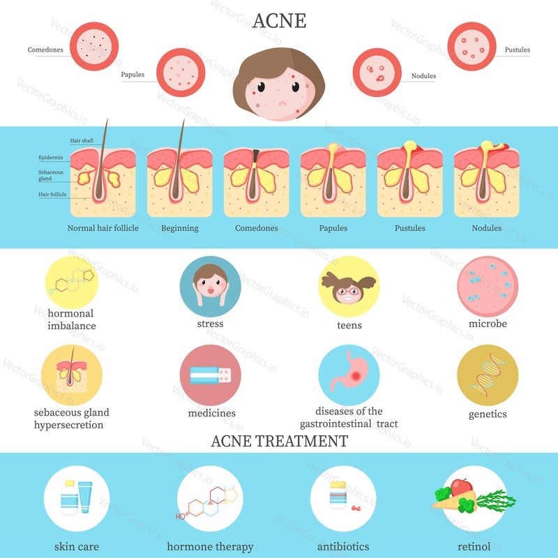 Acne types, causes and treatment infographics, vector flat style design illustration. Skin disease, dermatology inflammatory disorder. Acne comedones formation, skin care and medical therapy diagram.