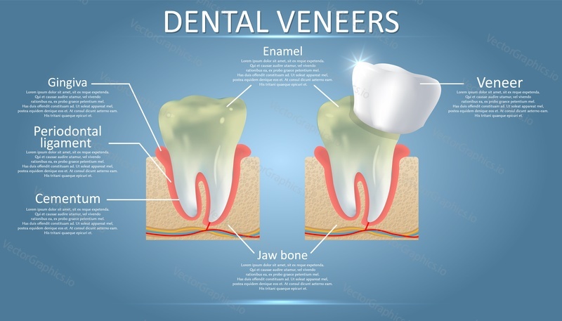 Dental veneers diagram, vector educational poster, medical infographic, presentation template. Dental restoration concept.