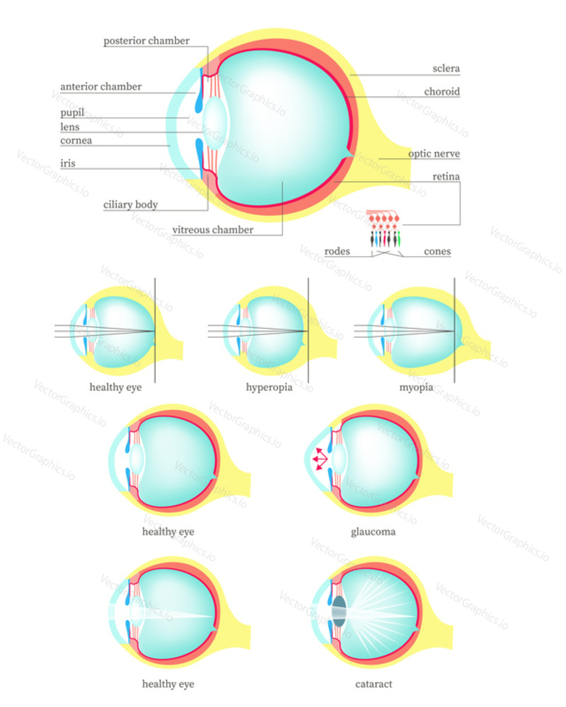 Медицинская диаграмма поперечного сечения анатомии человеческого глаза, векторная плоская изолированная иллюстрация. Строение здорового глаза и при заболеваниях и расстройствах, связанных с глаукомой, катарактой, дальнозоркостью, близорукостью.