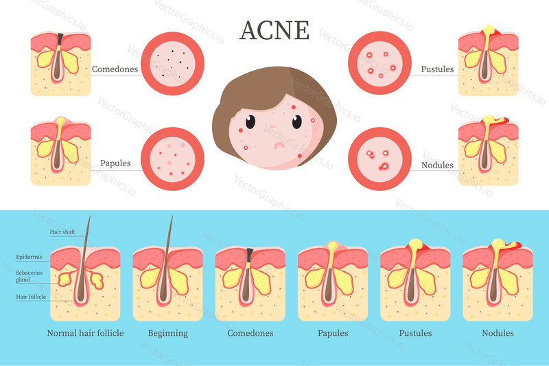 Acne types and progression stages infographics, vector flat style design illustration. Acne vulgaris comedones formation from normal hair follicle to nodules, skin disease diagram.