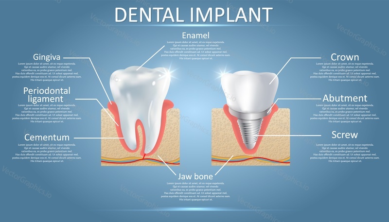 Человеческий зуб и зубной имплантат с прикрепленной к нему коронкой схема. Векторный образовательный плакат, медицинская инфографика, шаблон презентации. Концепция процедуры имплантации зубов.
