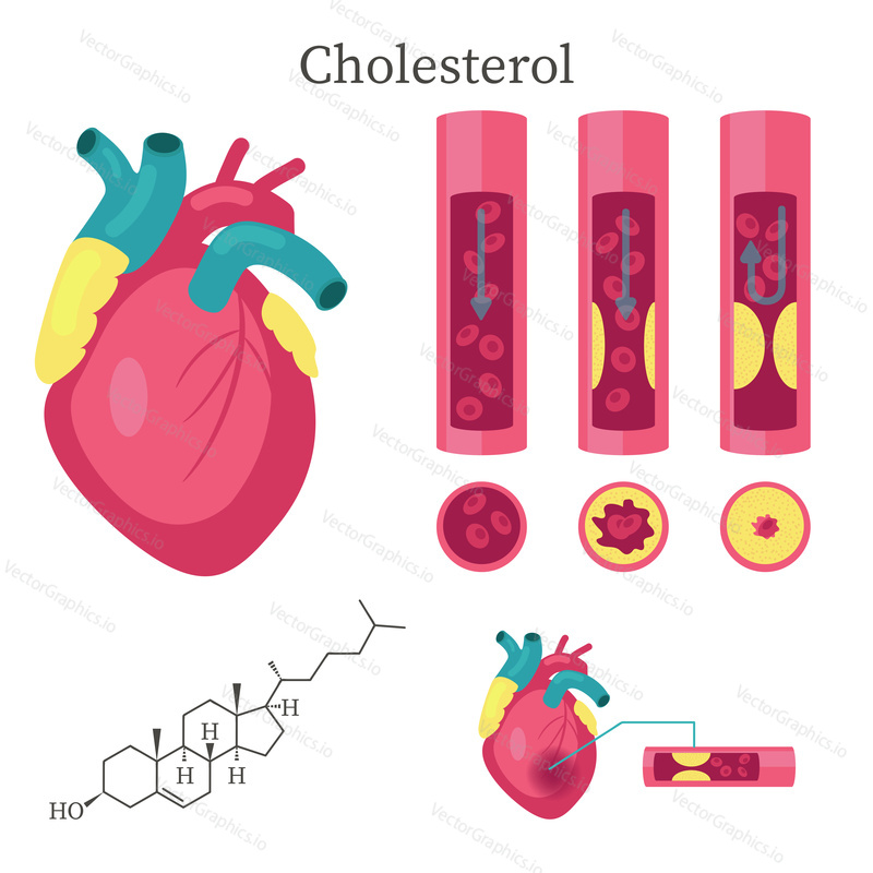 Холестерин в артерии, молекула холестерина, векторная плоская изолированная иллюстрация. Негативные последствия для здоровья, риск сердечных заболеваний.