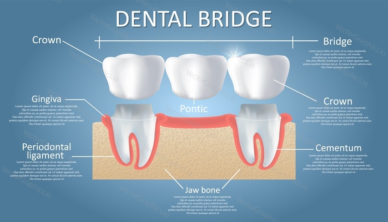 Схема зубного моста. Векторный образовательный плакат, медицинская инфографика. Традиционный мостовидный протез состоит из одного искусственного зуба и удерживается на месте зубными коронками. Несъемная реставрация зубов.