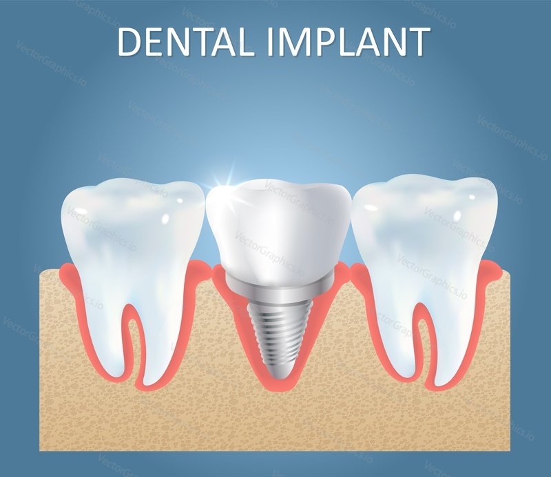 Tooth implant vector medical education anatomy poster template. Human teeth and dental implant with crown attached between them. Dental implantation of artificial root concept.