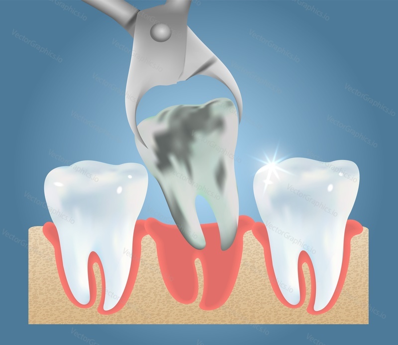 Шаблон векторного плаката по анатомии медицинского образования для удаления зуба. Процедура удаления зуба, концепция стоматологической хирургии.