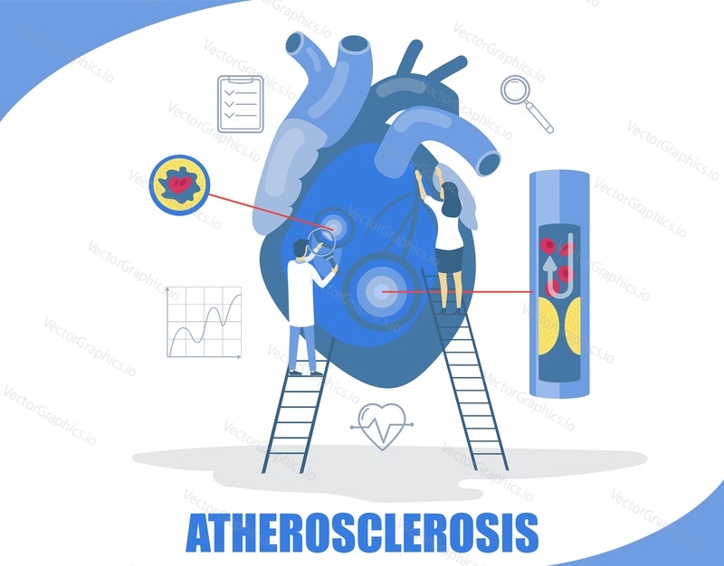 Векторная иллюстрация дизайна в плоском стиле концепции атеросклероза. Крошечные персонажи-врачи, исследующие большое человеческое сердце. Атеросклероз, ведущая причина сердечных приступов, инсульта, заболеваний периферических сосудов.