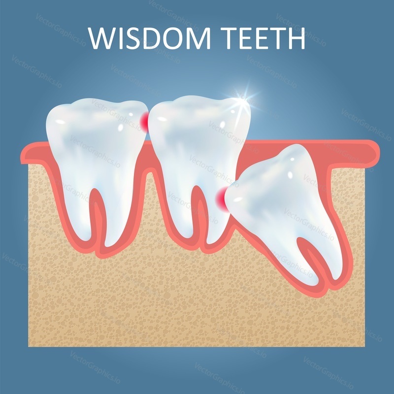 Wisdom teeth problems poster design template, vector realistic illustration. Impacted wisdom tooth that causes damage to other tooth. Dentistry, dental surgery concept.