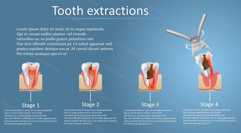 Tooth extraction concept vector poster banner template. Four steps of decay tooth removal process from dental caries to dental surgery. Teeth treatment and dental care concept.
