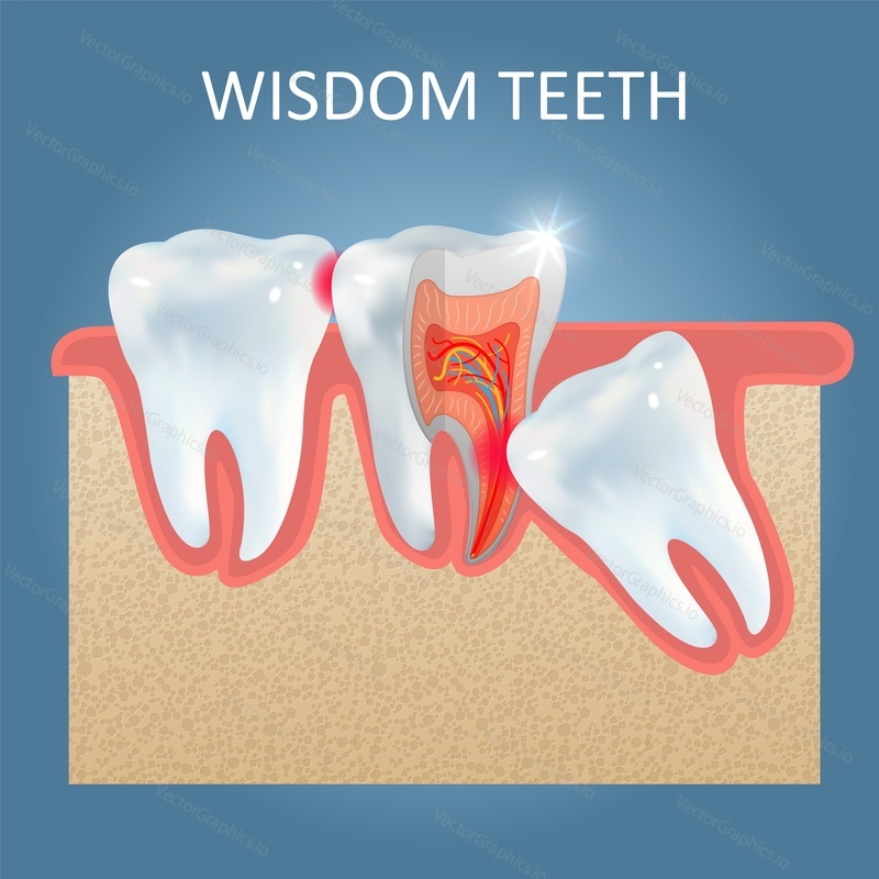 Wisdom teeth poster template, vector realistic illustration. Impacted wisdom tooth that causes dental problems such as tooth decay or caries to other tooth. Dental health concept.