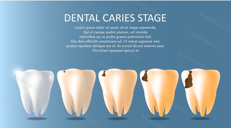 Dental caries stages vector medical poster banner template. White healthy tooth and bad teeth affected by caries. Oral care, stomatology concept.