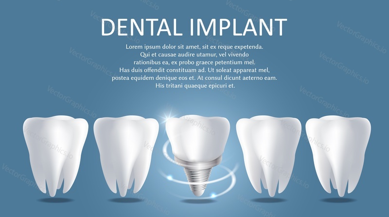 Dental implant vector medical poster banner template. Realistic human teeth and metal screw with crown attached between them. Dental surgery, tooth replacement concept.