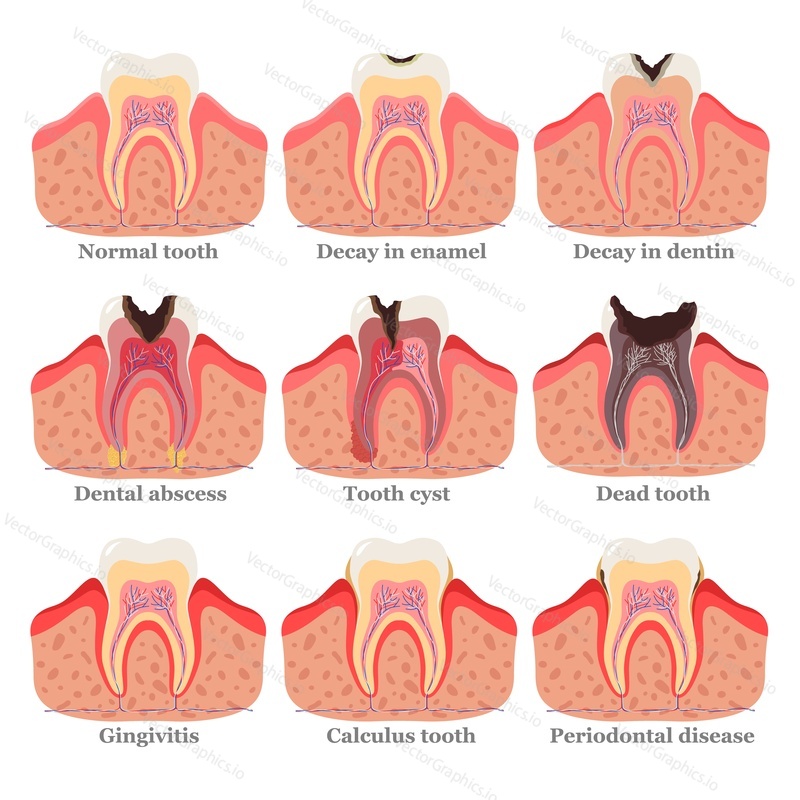 Tooth disorders set, flat vector illustration. Healthy and unhealthy teeth. Dental problems and diseases. Abscess, gingivitis, decay in enamel, decay in dentin, dead tooth, cyst, periodontal disease.