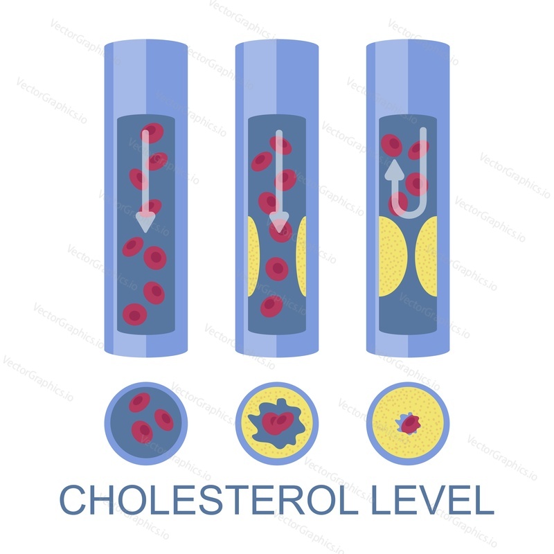 Low, normal, high cholesterol level, flat vector illustration. High ldl, bad cholesterol is risk factor for heart disease, atherosclerosis.