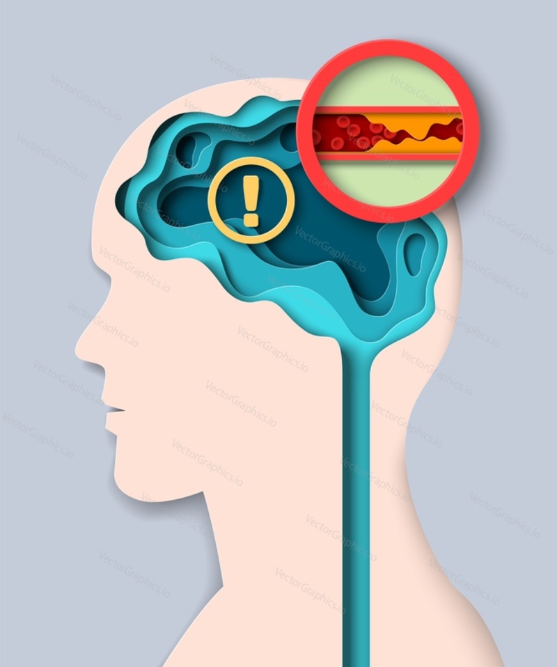 Медицинский вектор мозгового инсульта. Вырезанная из бумаги 3d-иллюстрация человеческой головы с сосудистым сгустком. Шаблон плаката по профилактике и лечению сердечно-сосудистых заболеваний. Концепция медицины, здоровья и неврологии