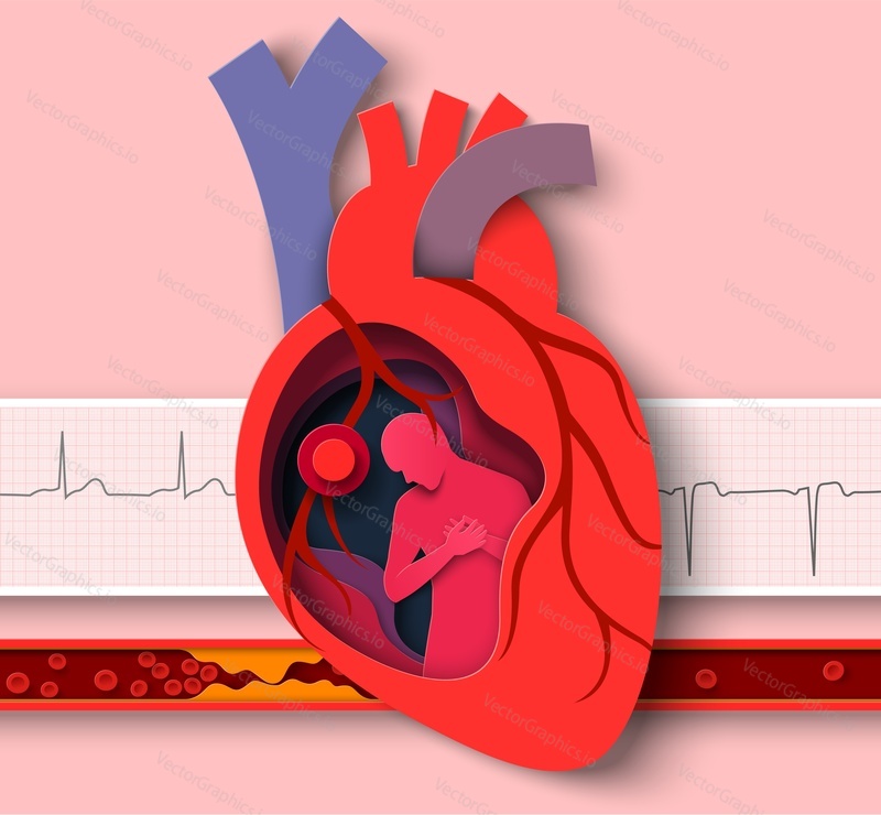Вектор вырезки из бумаги для сердечного приступа. Медицинский плакат по кардиологическим заболеваниям. Анатомия сердечно-сосудистого органа человека абстрактный дизайн и кардиограмма, иллюстрация атеросклеротического сосуда