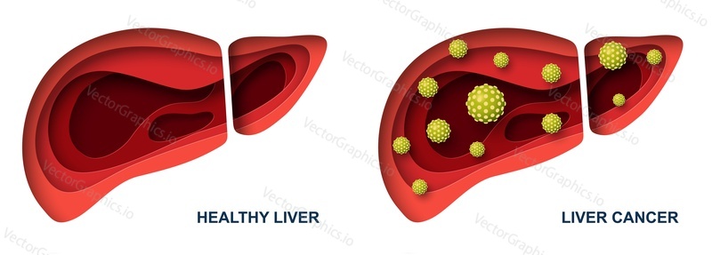 Liver cancer and healthy organ