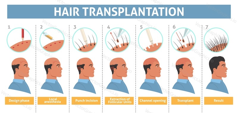 Векторный плакат с этапом пересадки волос мужчине. Лечение лысого мужчины с помощью иллюстрации имплантата. Инфографика о лечении алопеции. Процедура мезотерапии и удаления фолликулярных узлов