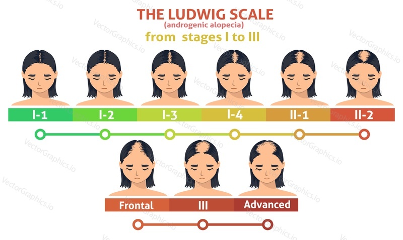 Ludwig scale of androgenic alopecia. Female balding progress poster. Hairloss problem infographic. Woman with hairloss symptom in three stage illustration