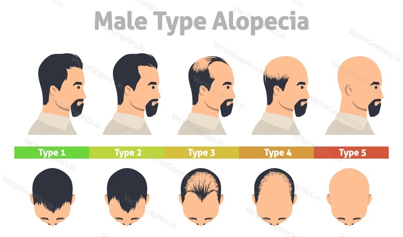 Male type alopecia poster. Hair loss stage vector. Man scalp with androgenetic balding progress. Hairline thinning process illustration