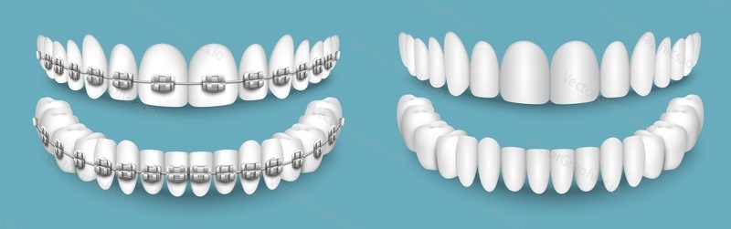 Зубы с брекетами или без них, векторная иллюстрация до и после выравнивания. Ортодонтическая стоматология, каппы и концепция ухода за зубами