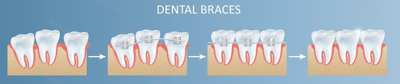 Этапы установки зубных брекетов векторная иллюстрация плаката. Стоматологическая медицина, стоматология и концепция лечения зубов