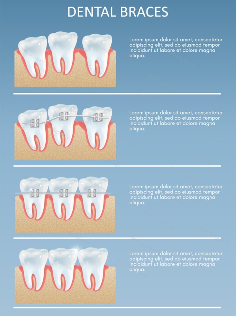 Dental braces installation for for straightening and treating teeth infographic brochure. Orthodontic dentistry vector poster. Healthy lifestyle and oral care medical illustration