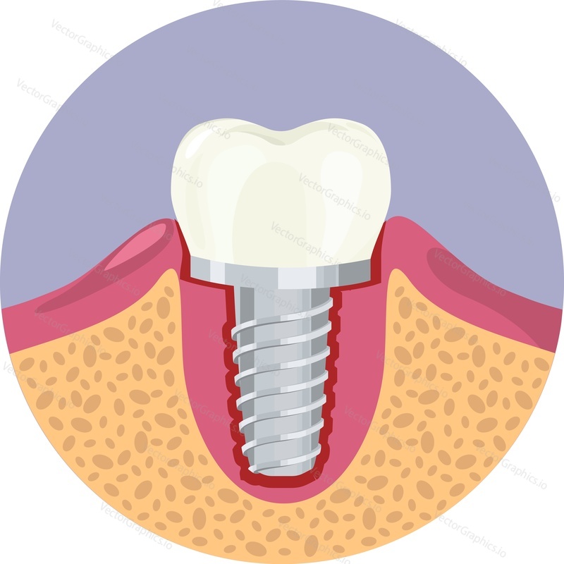 Tooth implant installation vector icon isolated on white background
