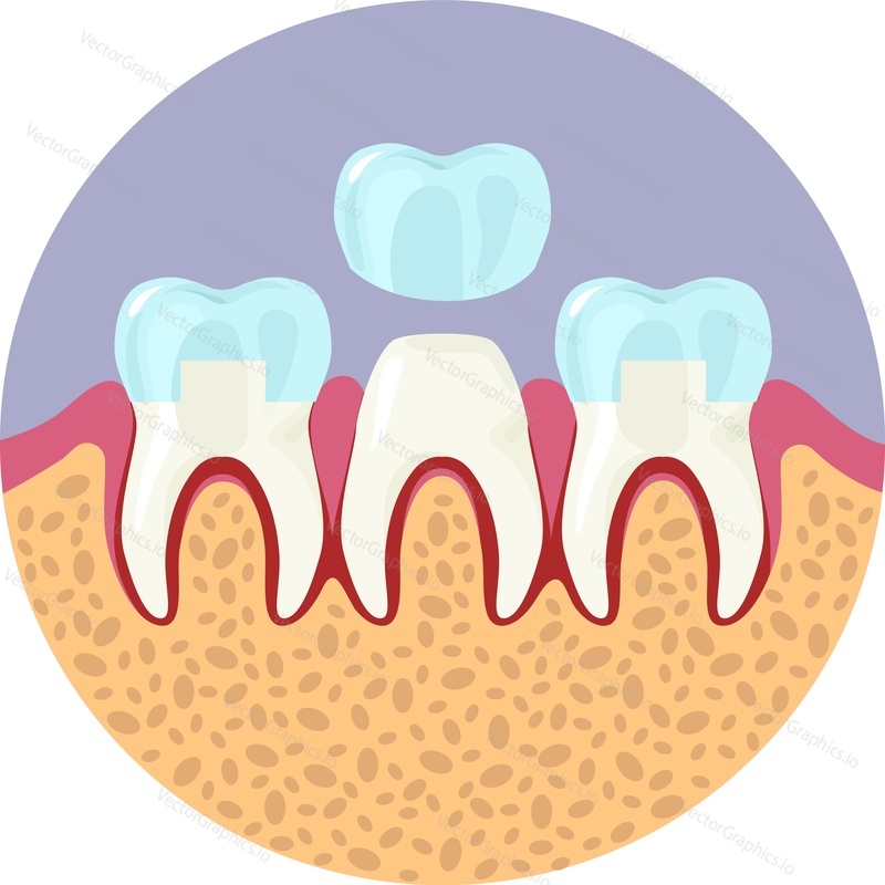 Tooth veneers installation vector icon isolated on white background
