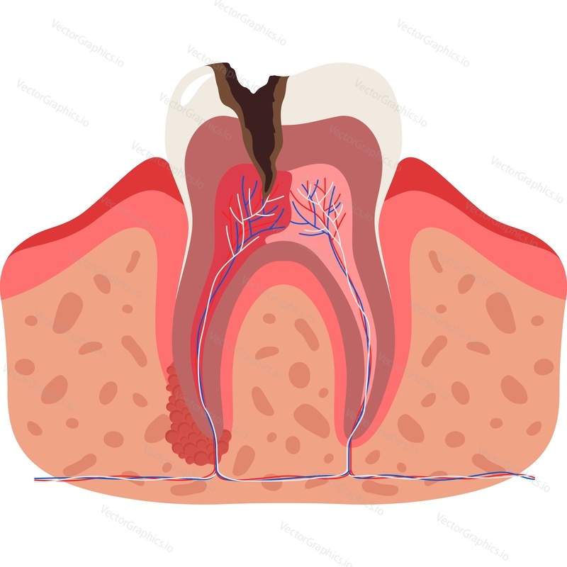 Больной зуб с дыркой и воспалением векторный значок анатомии зубов, изолированный на белом фоне