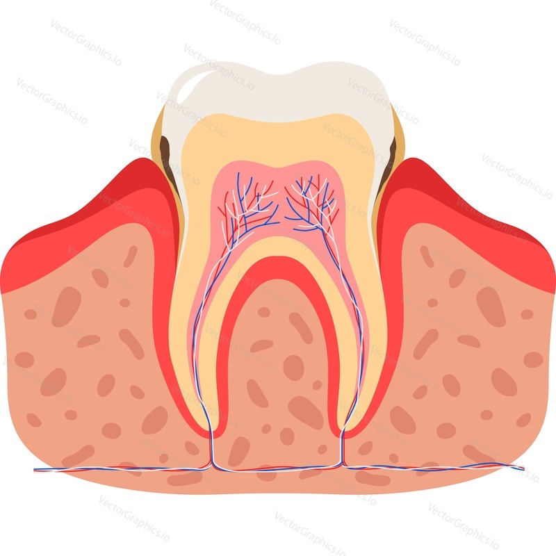 Векторный значок анатомии зубов при кариесе, изолированный на белом фоне