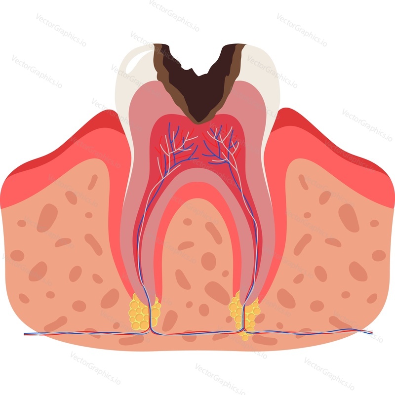 Больной разрушенный зуб с гниющими корнями векторная иконка анатомии зубов, изолированная на белом фоне