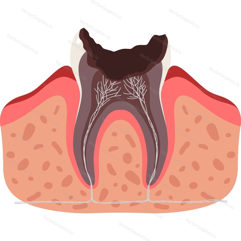 Больной разрушенный зуб векторная иконка анатомии зубов, изолированная на белом фоне